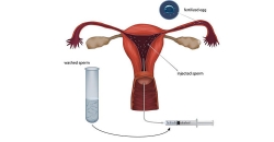 Artificial Insemination