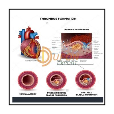 Clot Formation in Artery Chart