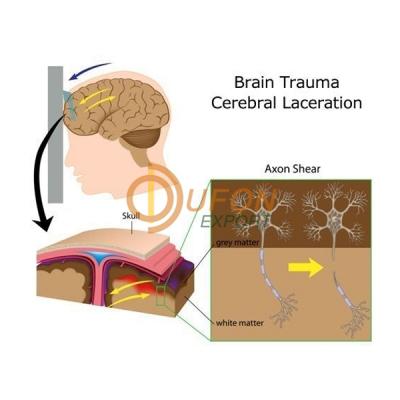 Laceration of Brain Model