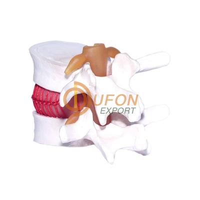 Disc Prolapse Simulator Model