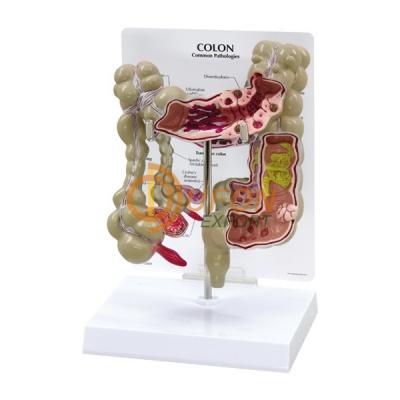 Colon Model With Pathologies