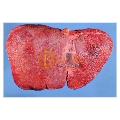 Micronodular Cirrhosis Model