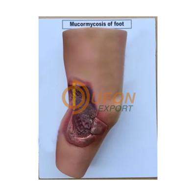 Mu cor Mycosis of Foot Model