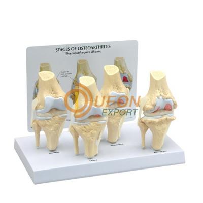 Four-Stage Osteoarthritis Knee Model