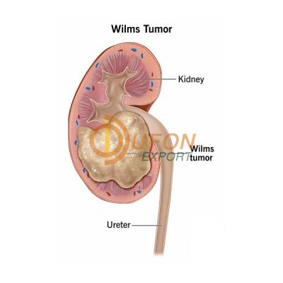 Wilms Tumor Model