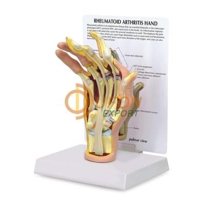Hand Arthritis Model