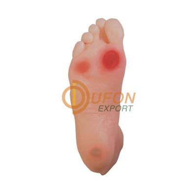 Diabetic Foot Model