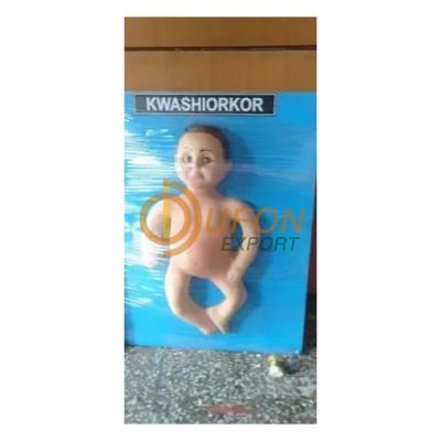 Kwashiorkor Model