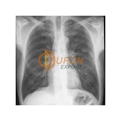 T.B. Infiltration in Lungs Model