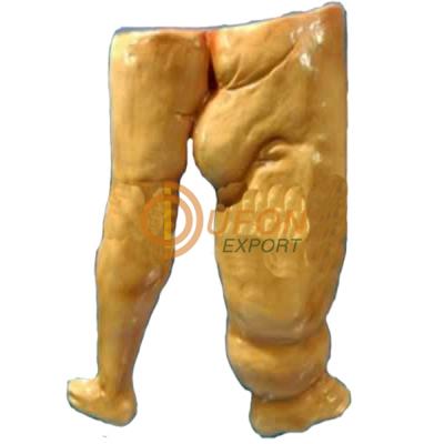 Elephantiasis Model