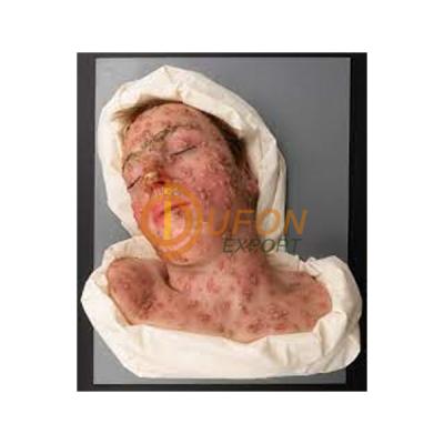 Small Pox Face Model