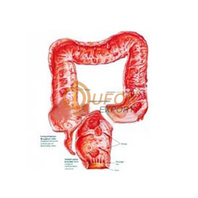 Familial Polyposis of Large Intestine Model