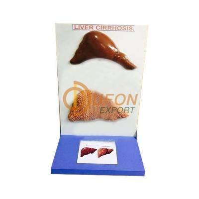 Cirrhosis Liver Model