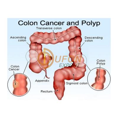 Colon Cancer and Polyp Model