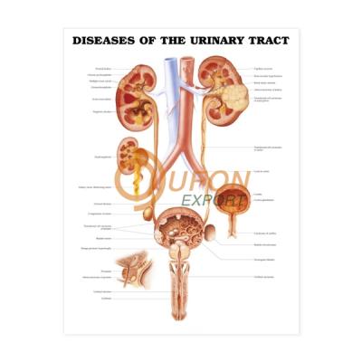 Urinary Tract Calculi Model