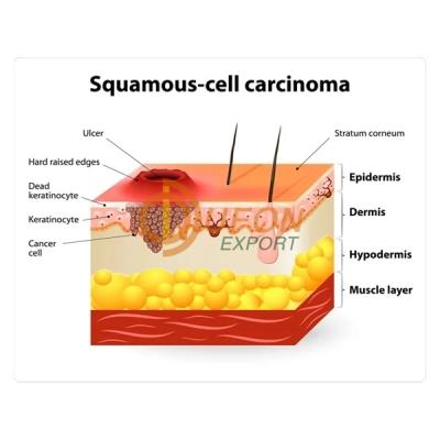 Squamous Cell Carcinoma Model