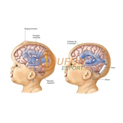 Hydrocephalus Model