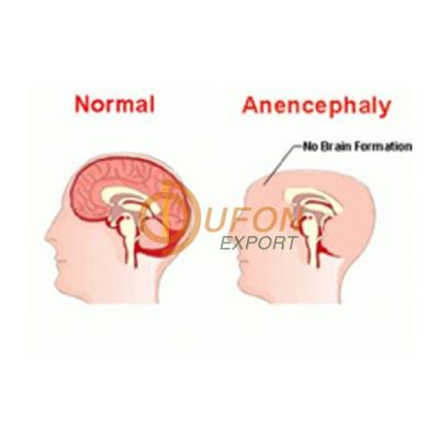 Anencephaly Model