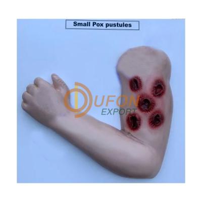 Small Pox Pustules Model