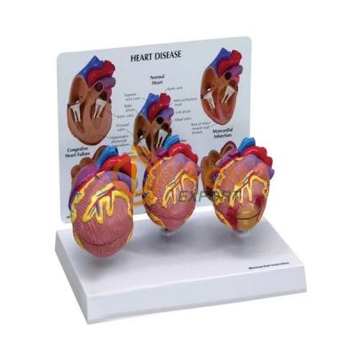 Human Heart Disease Model